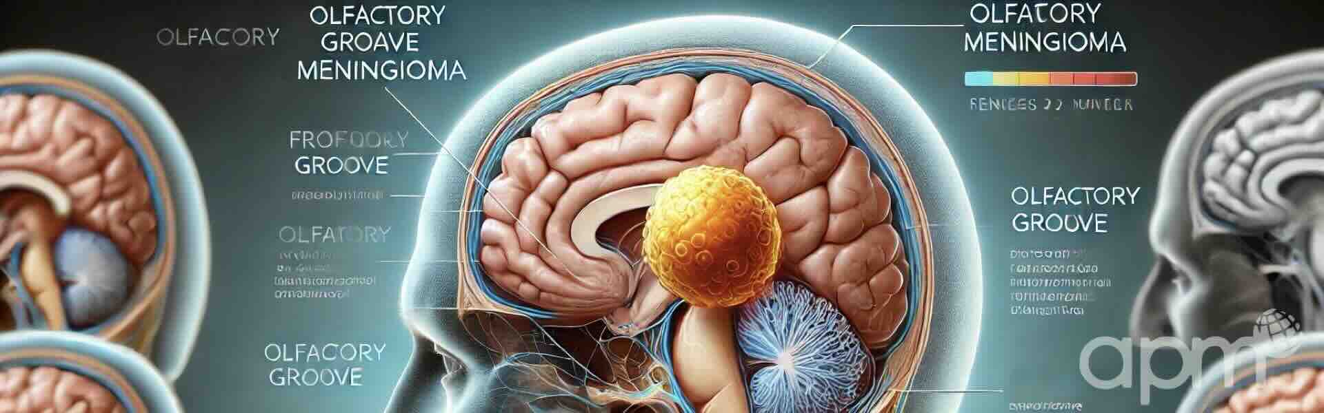 Olfactory Groove Meningioma